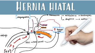 HERNIA HIATAL RGE funduplicatura nissen  paraesofagica [upl. by Eipper663]