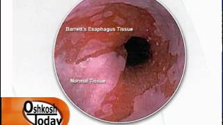 Barretts Esophagus [upl. by Aihsekel277]