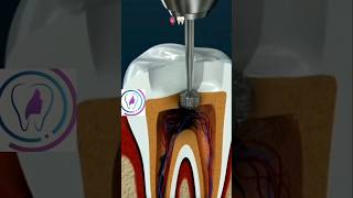 Root Canal treatment rootcanalspecialist rootcanals rootcanaltherapy dental cosmeticdentistry [upl. by Jory]