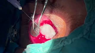 Modified Pterygium Surgery  Wills Hospital USA with Conjuctival Autograft using Mitomycin C [upl. by Revned]