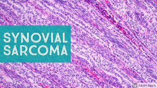 Synovial Sarcoma 101…Explained by a Soft Tissue Pathologist [upl. by My]