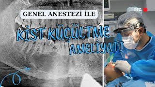 GENEL ANESTEZİ İLE DİŞ KİSTİ KÜÇÜLTME AMELİYATI  PROF DR MUSTAFA TEK [upl. by Asirrak]