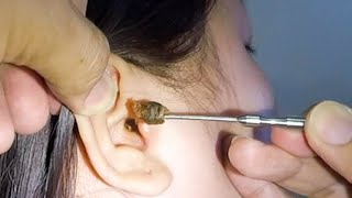 Removing One HUGE EARWAX Stuck in Womans Ear [upl. by Sorcha]