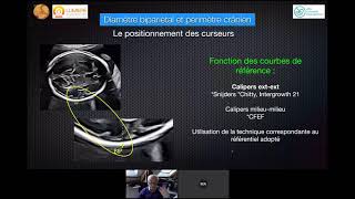 BIOMÉTRIE FOETALE BIEN MESURER  ÉCHOGRAPHIE OBSTÉTRICALE [upl. by Damali56]