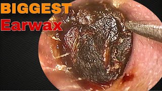 BIGGEST Earwax Difficult Removal EP 10  Doctor Anh [upl. by Pradeep]