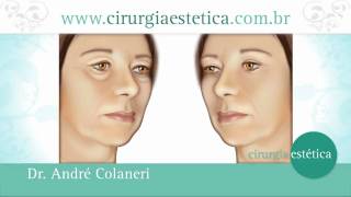 Cirurgia das Pálpebras  Blefaroplastia  Cirurgia Plástica Dr André Colaneri [upl. by Suiramed]