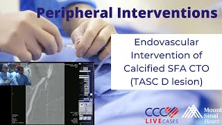 Endovascular Intervention of Calcified SFA CTO TASC D lesion  December 18 2013 Live Case Video [upl. by Farlay]