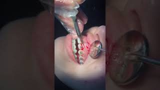 Gingivectomy for orthodontics treatment [upl. by Litch]