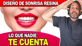 ¿Cuánto Dura un Diseño de SONRISA con RESINA  Te explico las Ventajas y Desventajas La VERDAD👇 [upl. by Brant]