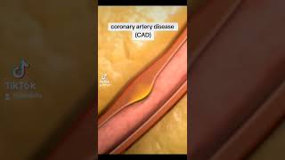 Coronary artery disease biology fun shortsvideo study education [upl. by Lydon]