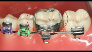 Molar Bands What they are and how they Work orthodontics [upl. by Franklin]