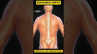 Zimmer Infix  medical animation 3d short  BiologywithAliya [upl. by Ytok]