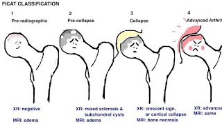 What is avascular necrosis [upl. by Muir299]