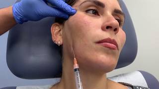 Sculptra treatment for correcting facial volume loss and antiaging by Dr Shaun Patel in Miami FL [upl. by Nila]