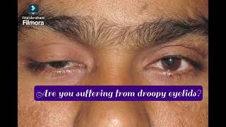 Are you suffering from droopy eyelidsDon’t hesitate to see your Oculoplasty Surgeon [upl. by Blaise]