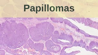 What are Papillomas  Pathology mini tutorial [upl. by Najram]