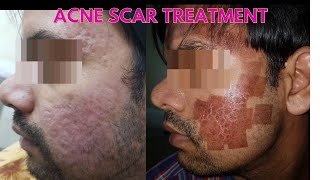 Laser acne scar removal  Before and after results  Laser treatment for scars [upl. by Tippets]