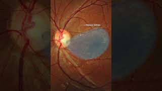 Optic disc pit maculopathy [upl. by Ardaid]