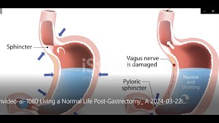 Living a Normal Life Post Gastrectomy [upl. by Jaime]