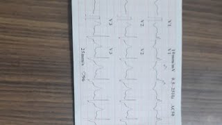 LEARN ECG VENTRICULAR BIGEMINY WITH RBBB IN 2 MINUTES [upl. by Zea]