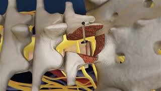 Lumbar Fusion of L5 S1 Animation TLIF Spine Fusion  DR SHASHIDHAR B K [upl. by Niuq]