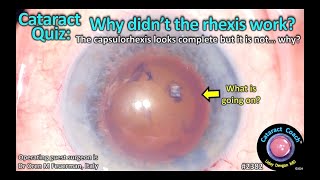 CataractCoach™ 2382 Cataract Quiz Why didnt the capsulorhexis work [upl. by Nennerb650]