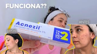 RESENHA usei o ACNEZIL por 20 dias e olha o resultado [upl. by Ranjiv]