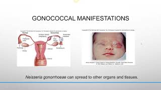 Select Infections of the Urogenital System [upl. by Enairb]