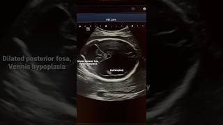 Multiple Fetal Anomalies ultrasoundDandy Walker hydrocephalyARPKD sonography sonographer ardms [upl. by Hardwick71]