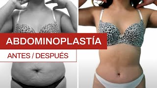 👨‍⚕️Consejos Postoperatorios LIPECTOMIA o ABDOMINOPLASTIA👨‍⚕️ [upl. by Notsirk474]