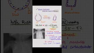 Infant Respiratory Distress Syndrome شرح حالة IRDS انشروهاللاستفادة [upl. by Welcome]