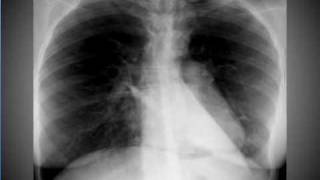 Chest xray Pneumomediastinum [upl. by Vladimir]