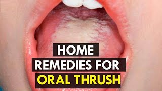 How to Treat Candida at Home  5 Home Remedies for Oral Thrush [upl. by Edd979]