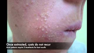 Acne cyst laser treatment [upl. by Jenne554]