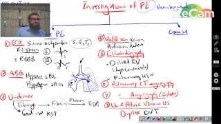 Pulmonary Embolism 1  Investigations [upl. by Urbai268]