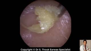 Top Biggest Ear Wax Removal 107  Ear wax Extraction  Dr S Thouk Earwax Specialist [upl. by Evelc976]