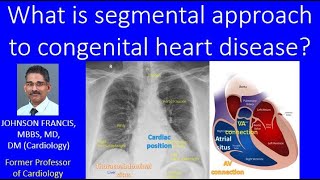 What is segmental approach to congenital heart disease [upl. by Arbba]