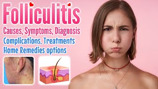 Folliculitis definition causes symptoms diagnosis complication treatment and home remedies [upl. by Odlabu]