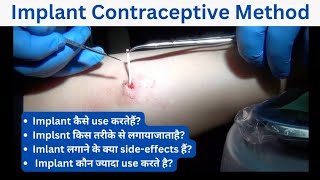 Implant contraceptive method  implant contraceptive side effects  implant contraception in hindi [upl. by Opal]