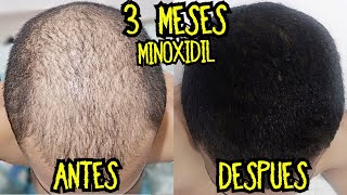 REPOBLANDO el Cuero Cabelludo 3 MESES con MINOXIDIL SAW PALMETTO y Más  Tratamiento Calvicie [upl. by Fanchon189]