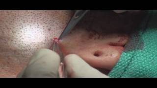 Acne Scar Revision Part 02 Subcision Technique by Dr Young [upl. by Maiocco]