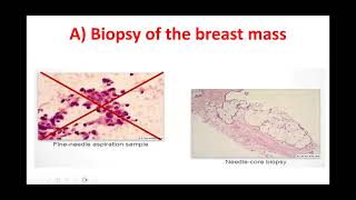 Breast cancer Staging workup part 12 Basics of Breast cancer course [upl. by Elimay]