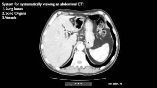 How to interpret an abdominal CT [upl. by Elehcor562]