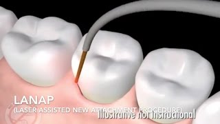 How Does Laser Surgery Work Treat Gum Disease  LANAP [upl. by Jacobsohn469]