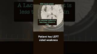 Left sided weakness What does the MRI Head show  radiology acute neurology [upl. by Suh16]