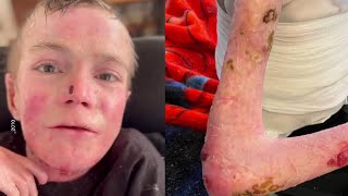 TikToker Dies of Rare Genetic Disease That Causes Skin to Blister [upl. by Jeff184]