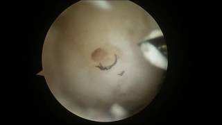 Arthroscopic Microfracture of the Knee with PowerPick [upl. by Hisbe]