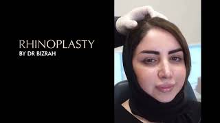 Beyond Beauty A Patients Story of Rhinoplasty with Dr Bashar Bizrah [upl. by Onidranreb]