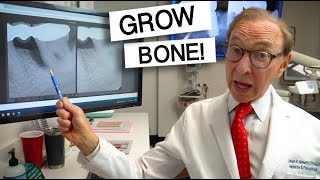 AMAZING Results of BONE GROWTH With Gum Disease Treatment [upl. by Aunson925]