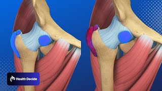 Hip Pain Trochanteric Hip Bursitis  3D Animation [upl. by Lydnek706]